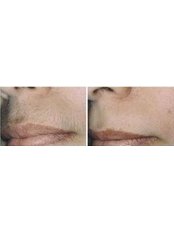 Laser Hair Removal - Lip - Package of 6  - The Chiltern Medical Clinic - Central Reading