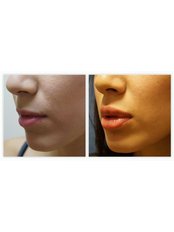 Lip Augmentation - The Chiltern Medical Clinic - Central Reading