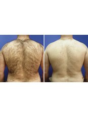 Laser Hair Removal - Full Back (Inc. Back of Neck) - Package of 3 - The Chiltern Medical Clinic - Central Reading