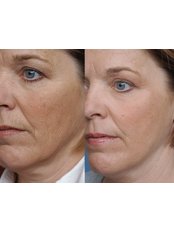 Skin Rejuvenation - The Chiltern Medical Clinic - Central Reading