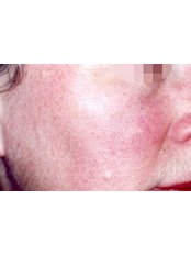 Facial Thread Veins Treatment - Permanent Beauty