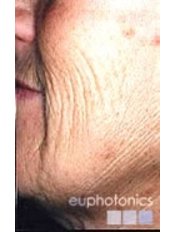 Laser Wrinkle Reduction - Permanent Beauty