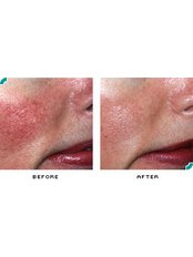 Rosacea Treatment - Permanent Beauty