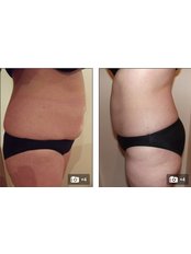 Fat Dissolving Injections - Bristol Cosmetic Clinic