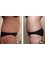 Bristol Cosmetic Clinic - Shift That Unwanted Fat With Aqualyx Fat Burning Treatment 