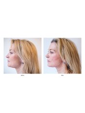 Lunch Time Facelift - Bristol Cosmetic Clinic