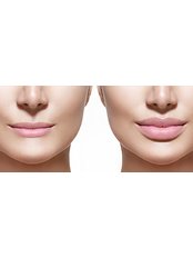 Love Your Lips With Lip Fillers - Bristol Cosmetic Clinic