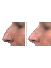 Non-Surgical Nose Job - Seraphina Aesthetic Clinic