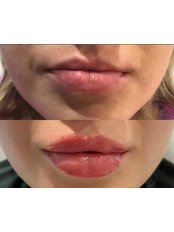 Lip Augmentation - Cokely Aesthetics
