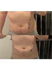 Fat Reduction Injections - Cokely Aesthetics