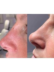 Non-Surgical Nose Job - Cokely Aesthetics