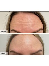 Treatment for Wrinkles - The Hampton Clinic