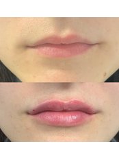 Lip Augmentation - Visage Clinic