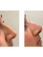 Non-Surgical Nose Job - Visage Clinic