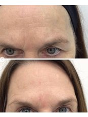 Treatment for Wrinkles - Hunar Clinic