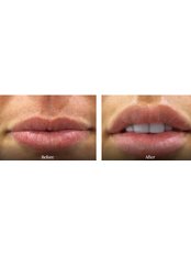 Lip Augmentation - The FAB Practice