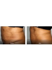 3D-Lipo - The FAB Practice
