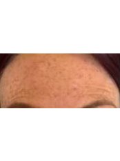 Treatment for Wrinkles - Perfect Symmetry Aesthetics Skin Clinic Cambridge