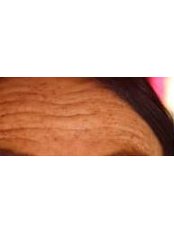 Treatment for Wrinkles - Perfect Symmetry Aesthetics Skin Clinic Cambridge