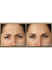 Treatment for Wrinkles - The Cosmetic Clinic - Peterborough