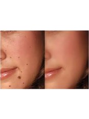 Fractional CO2 for mole removal - The Cosmetic Clinic - Peterborough