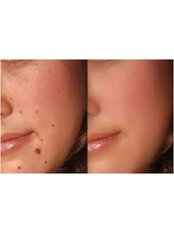 Mole Removal - The Cosmetic Clinic - Peterborough