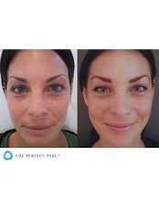The Perfect Peel - The Cosmetic Clinic - Peterborough