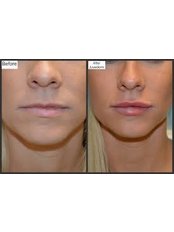Lip Augmentation - The Cosmetic Clinic - Peterborough
