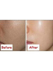 Microdermabrasion - The Cosmetic Clinic - Peterborough