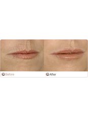 Lip Augmentation - The Cosmetic Clinic - Peterborough