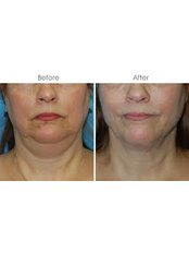 Fat Reduction Injections - The Cosmetic Clinic - Peterborough