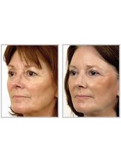 Fractional CO2 for mole removal - The Cosmetic Clinic - Peterborough
