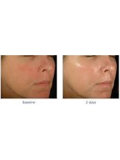 Microdermabrasion - The Cosmetic Clinic - Peterborough