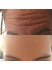 Before and after wrinkle reducing injections - City Aesthetics Chester