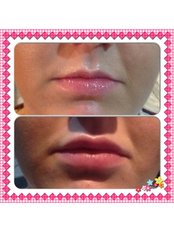 0.5ml upper lip augmentation - City Aesthetics Chester