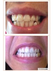 Before and after dental tooth whitening  - City Aesthetics Chester
