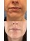 Medical Aesthetics Clinic - Chin Augmentation & Mentalis Muscle Relaxing  