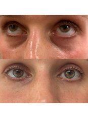 Tear Trough Under-eye Filler - Medical Aesthetics Clinic