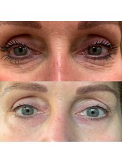 Tear Trough Under-eye Filler - Medical Aesthetics Clinic