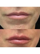 Lip Augmentation - Samantha Pierce Aesthetics