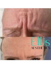 Treatment for Wrinkles - Ellis Aesthetics