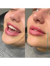 Lip Enhancements - Bliss Aesthetics