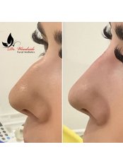 Non-Surgical Nose Job - Dr Woodside Facial Aesthetics