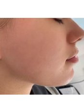 Chin Augmentation - Dr Woodside Facial Aesthetics