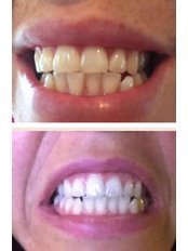 Teeth Whitening - Dr Woodside Facial Aesthetics