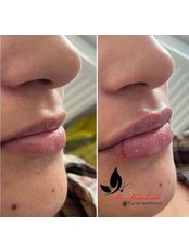 Lip Augmentation - Dr Woodside Facial Aesthetics