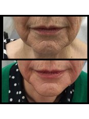 Before and after - Renew Medical Aesthetics
