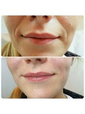 Lip Augmentation - Renew Medical Aesthetics