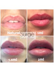 Lip Augmentation - Surge Medical Aesthetics
