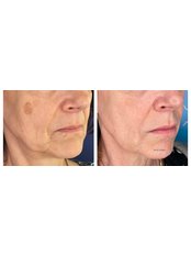 Age Spots Removal - Dr K’s Clinic